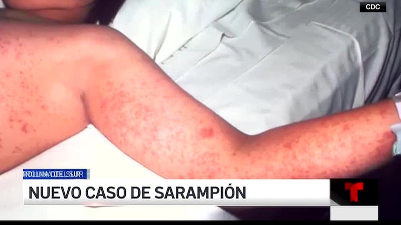 Autoridades informan de un nuevo caso confirmado de sarampión en Carolina del Sur.