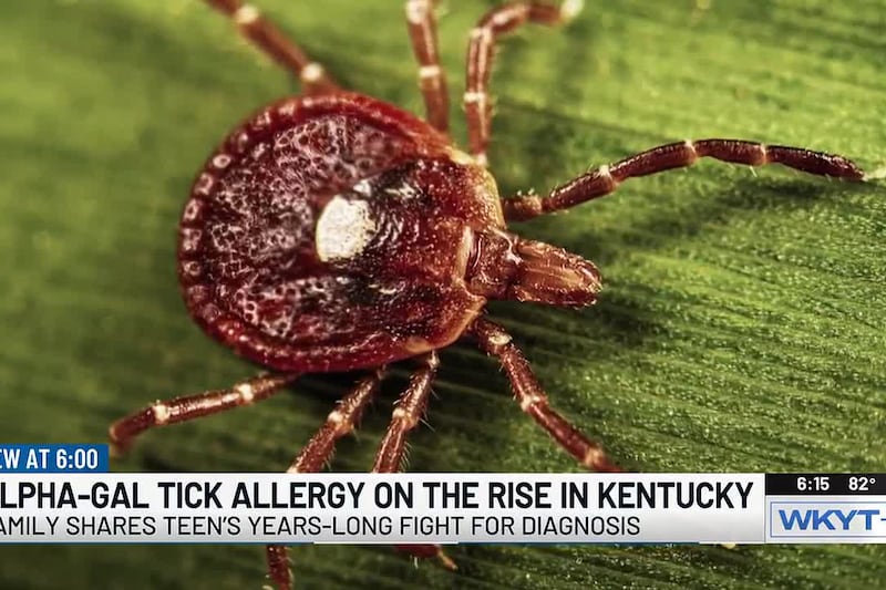 ‘It has flipped our life completely upside down’: KY teen living with tick-borne alpha-gal syndrome waited years for answers