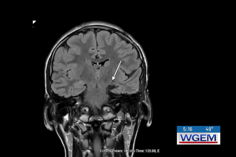 Brain surgery before high school